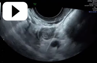 Perimenopausal Ovary
