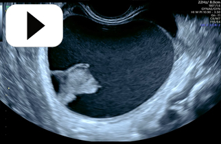 Common Benign Ovarian Cyst haemorrhagic Cyst with clot retraction
