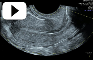 VCI -A plane proliferative endometrium